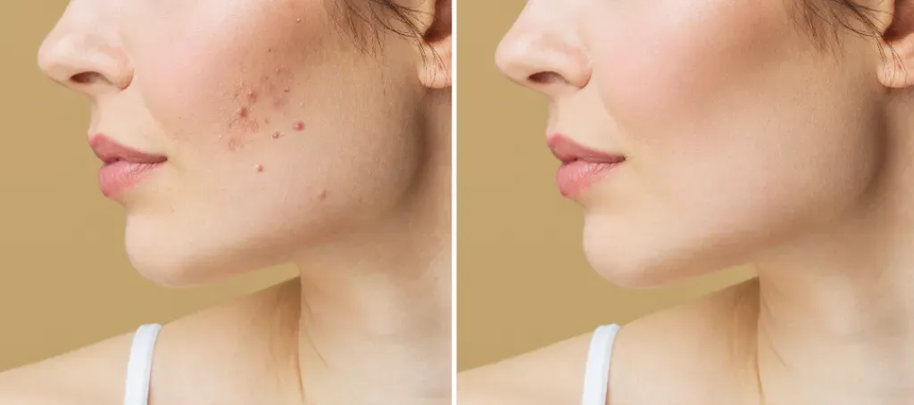 ​Przebarwienia po trądziku